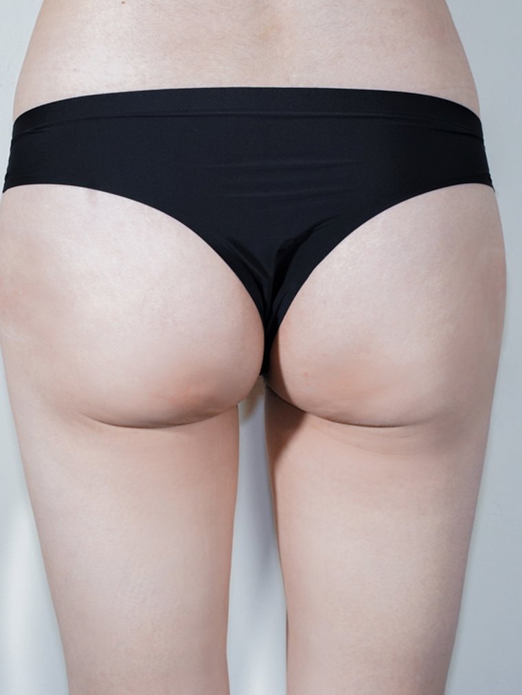 Fit-Sculptra (Body) at MILI Clinic Dosan — after, case 1