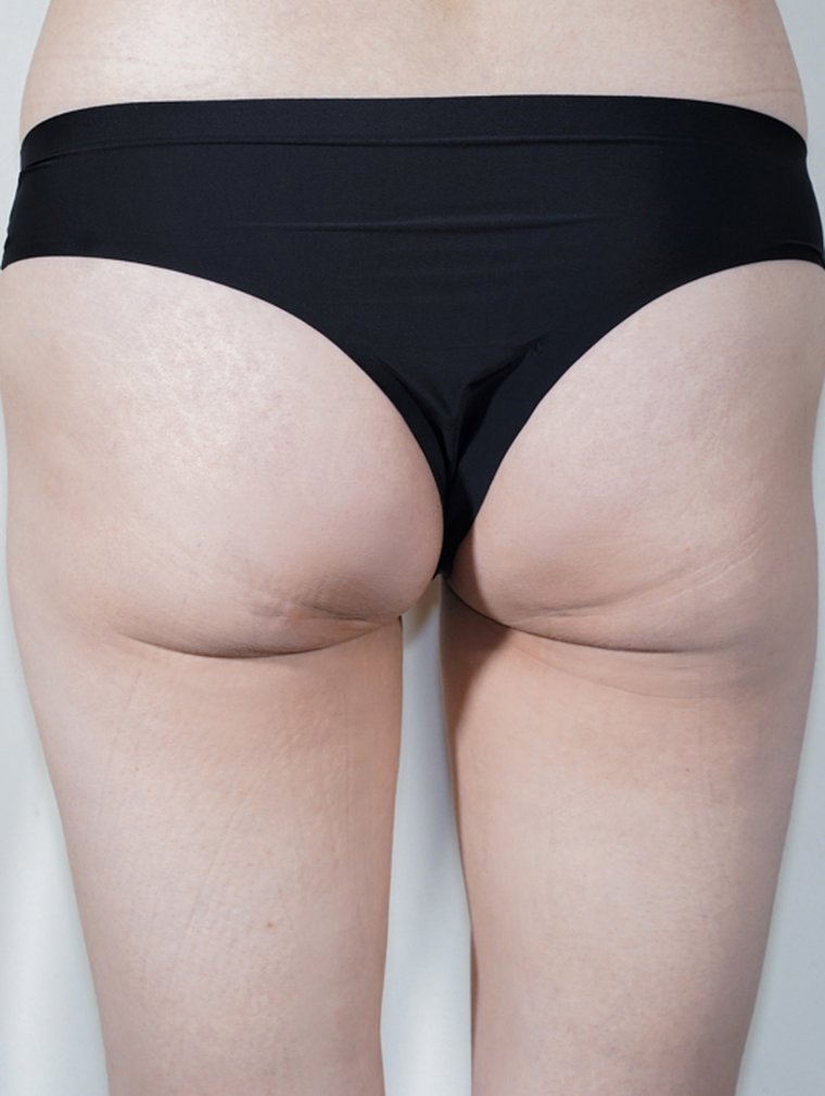 Fit-Sculptra (Body) at MILI Clinic Dosan — before, case 1