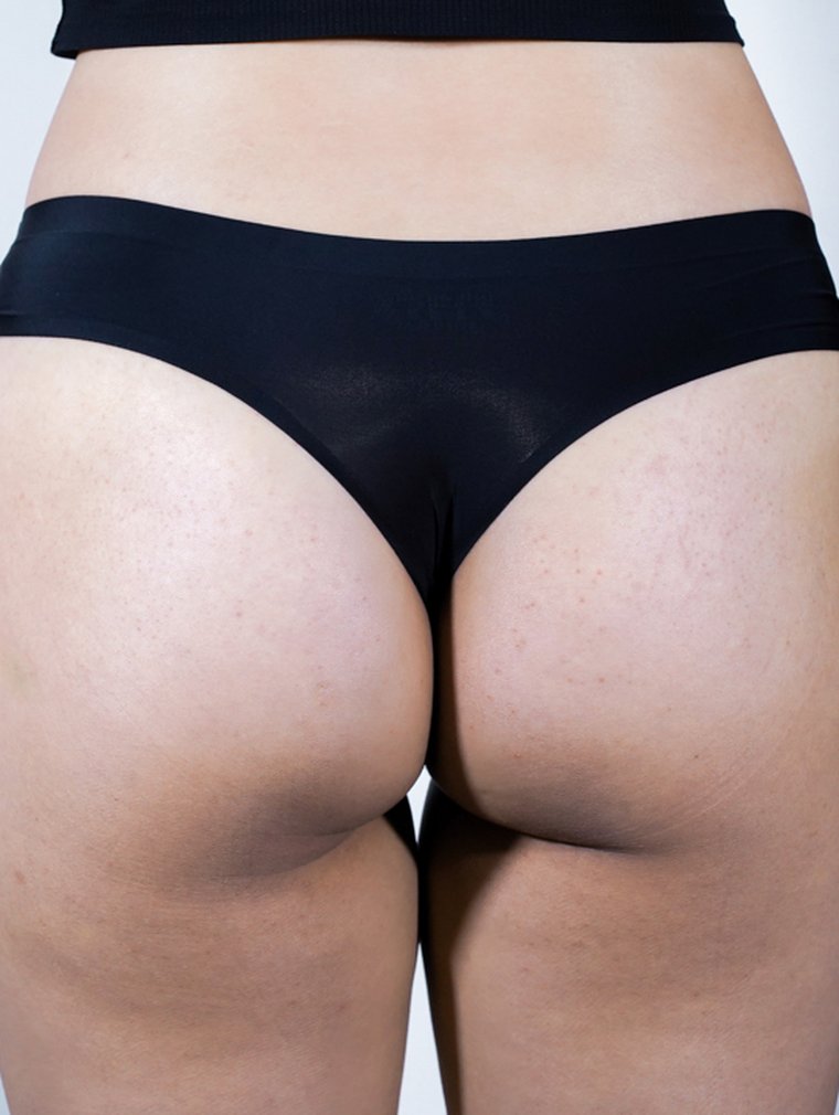 Fit-Sculptra (Body) at MILI Clinic Dosan — before, case 2