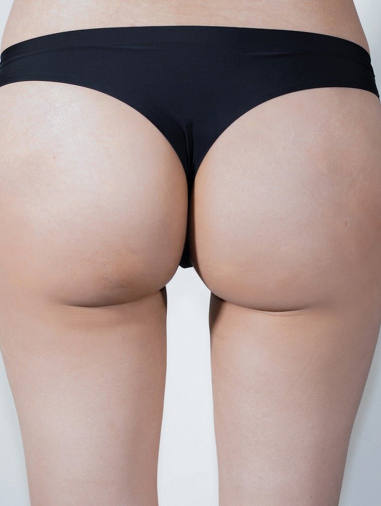 Fit-Sculptra (Body) at MILI Clinic Dosan — after, case 3