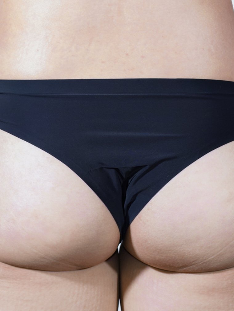 Fit-Sculptra (Body) at MILI Clinic Dosan — after, case 4