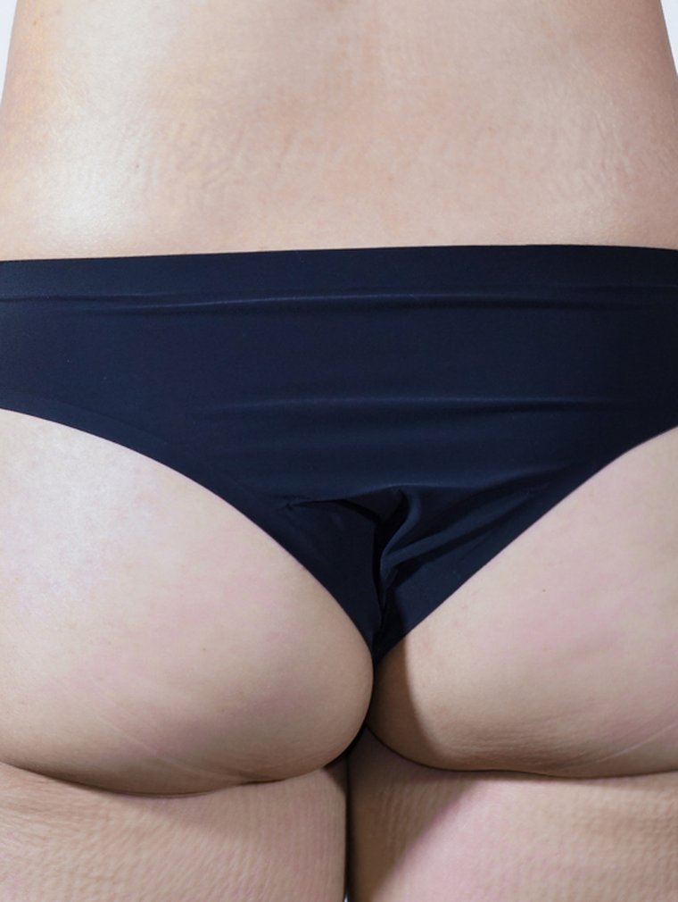 Fit-Sculptra (Body) at MILI Clinic Dosan — before, case 4