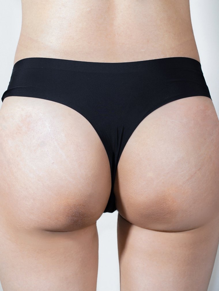 Fit-Sculptra (Body) at MILI Clinic Dosan — after, case 5