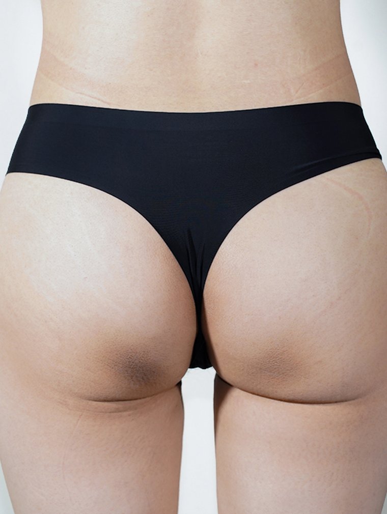 Fit-Sculptra (Body) at MILI Clinic Dosan — before, case 5