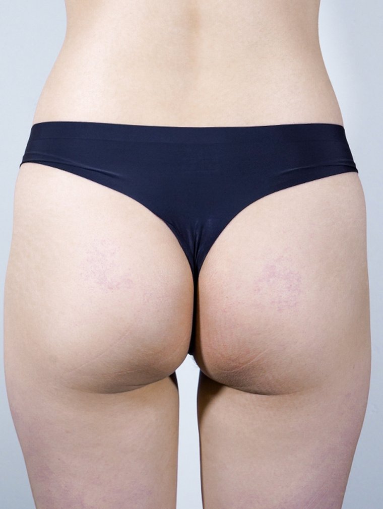 Fit-Sculptra (Body) at MILI Clinic Dosan — before, case 6
