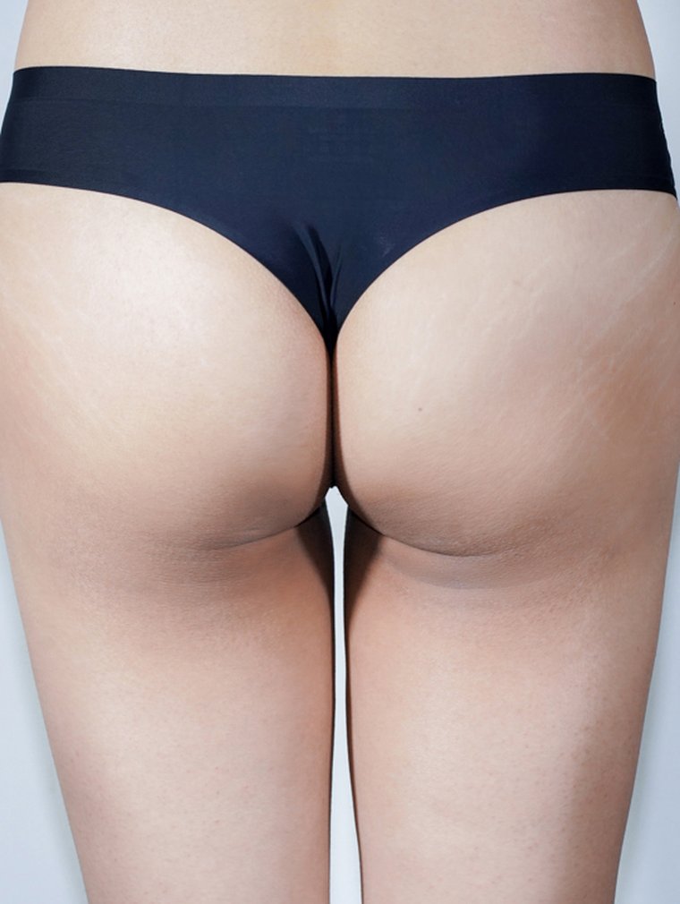 Fit-Sculptra (Body) at MILI Clinic Dosan — after, case 7
