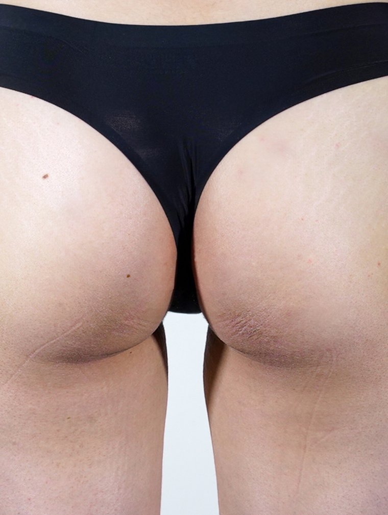Fit-Sculptra (Body) at MILI Clinic Dosan — before, case 8