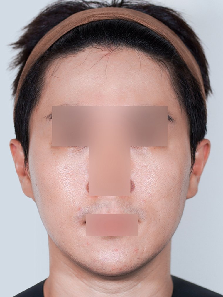 Derma Renewal at MILI Clinic Dosan — after, case 2