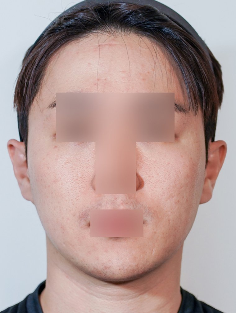 Derma Renewal at MILI Clinic Dosan — before, case 2