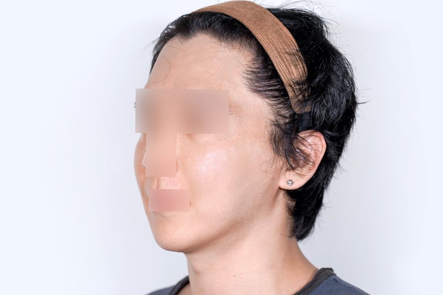 Thermage FLX after, MILI Clinic Dosan