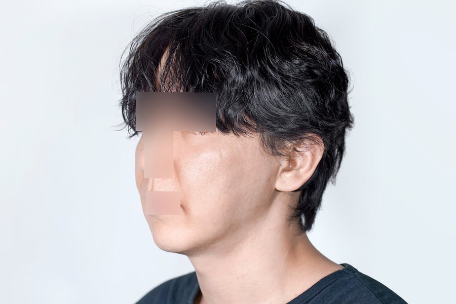 Thermage FLX before, MILI Clinic Dosan