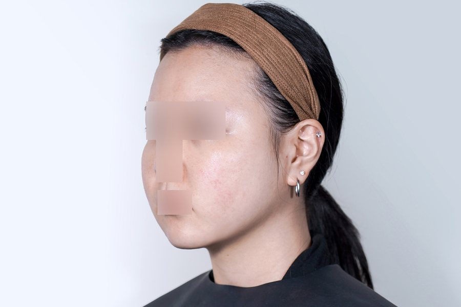Tuneface after, MILI Clinic Dosan