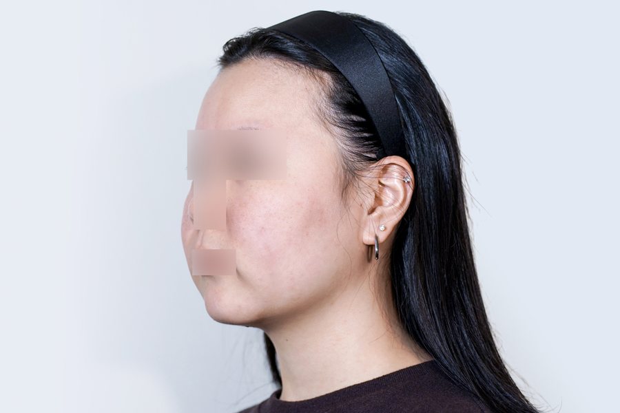 Tuneface before, MILI Clinic Dosan