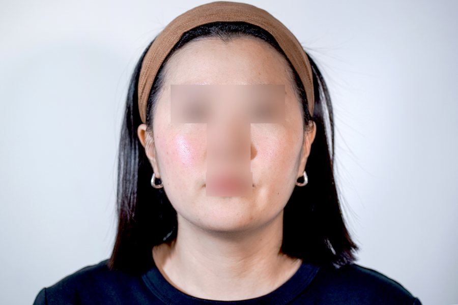 Ultherapy Prime after, MILI Clinic Dosan