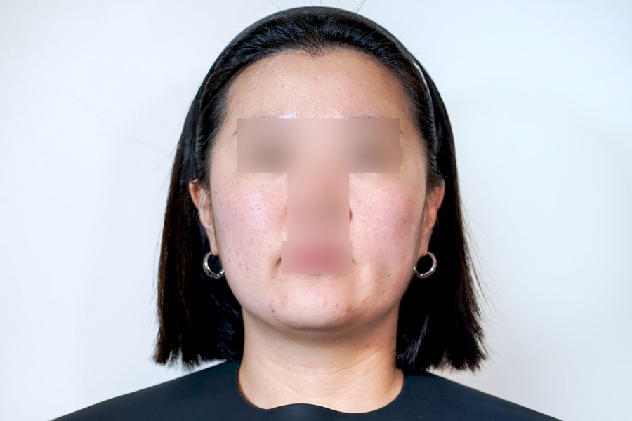 Ultherapy Prime before, MILI Clinic Dosan